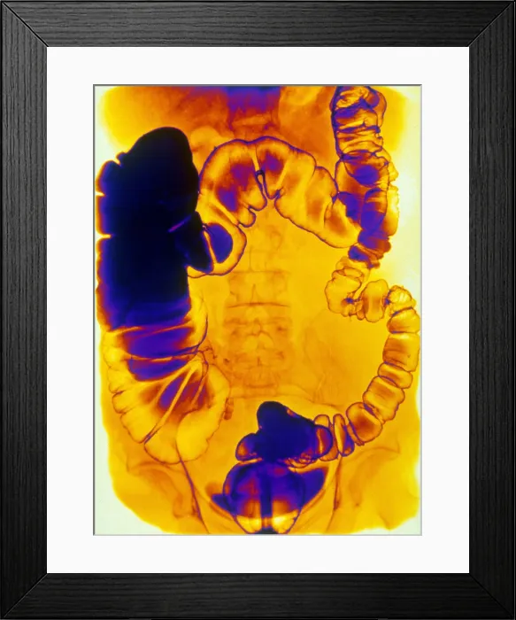 Framed Print : Large and Small Intestine, Barium X-ray Framed Print : Large and Small Intestine, Barium X-ray