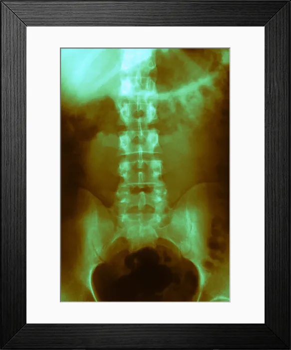 Framed Print : Normal Abdomen and Colon