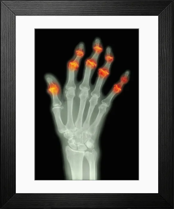 Framed Print : Degenerative Arthritis Framed Print : Degenerative Arthritis