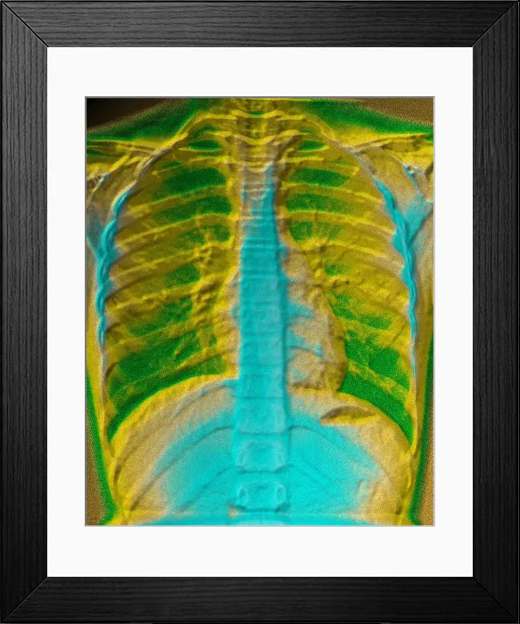 Framed Print : A normal chest X-ray Framed Print : A normal chest X-ray