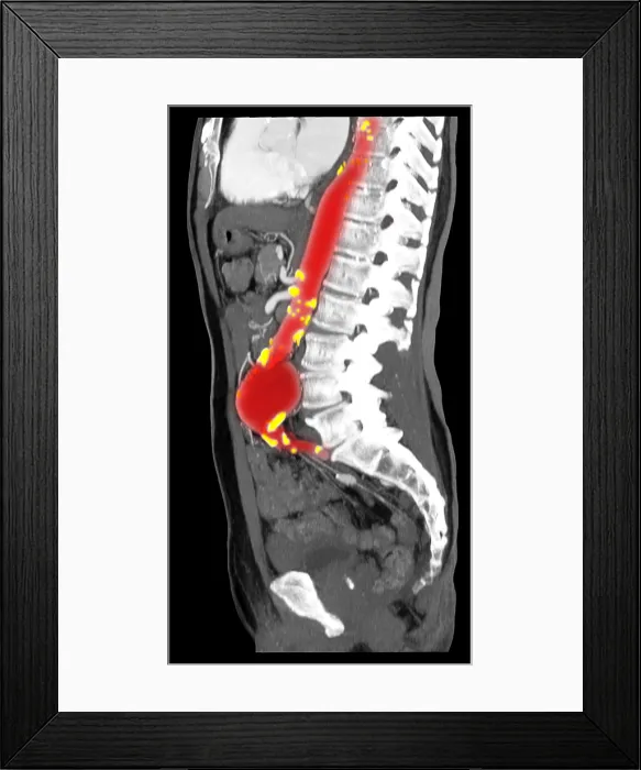 Framed Print : CT Scan of Abdominal Aortic Aneurysm