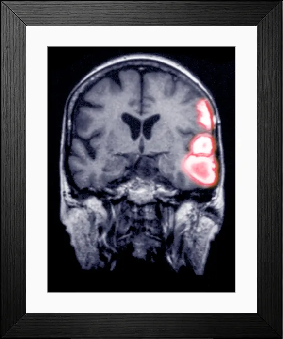 Framed Print : Temporoparietal brain hemorrhage, MRI Framed Print : Temporoparietal brain hemorrhage, MRI