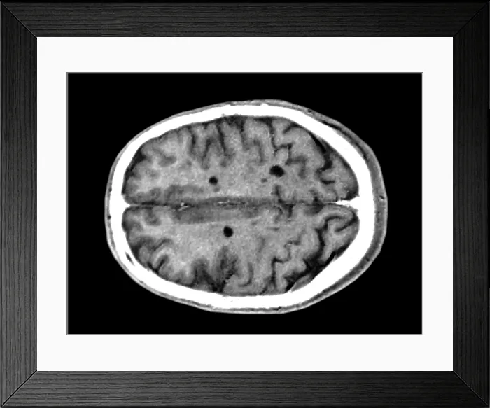 Framed Print : Multiple sclerosis brain lesions