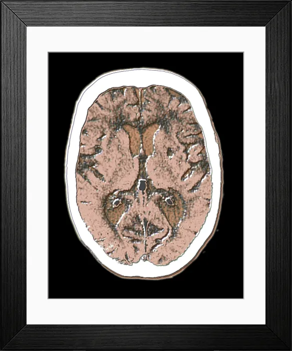 Framed Print : Cerebral CAT scan showing atrophy