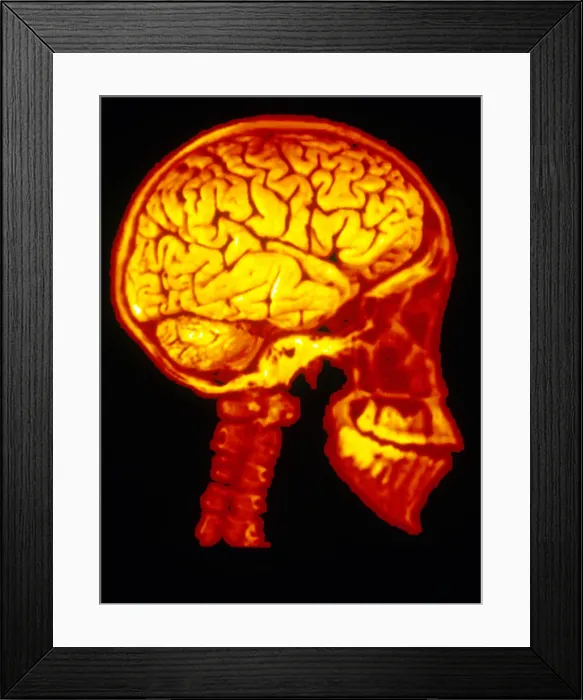 Framed Print : Human Skull X-Ray with Digitized Brain