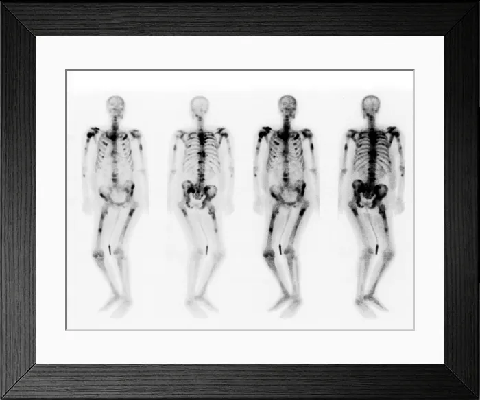 Framed Print : Bone scan showing multiple metastases Framed Print : Bone scan showing multiple metastases