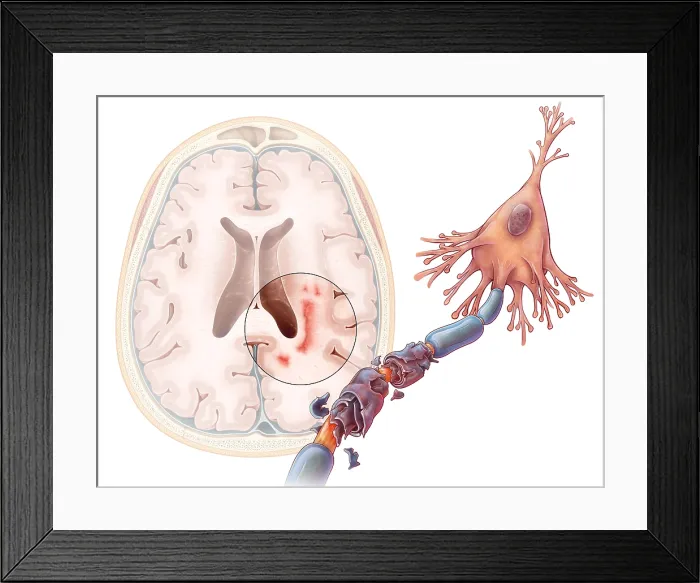 Framed Print : Multiple Sclerosis