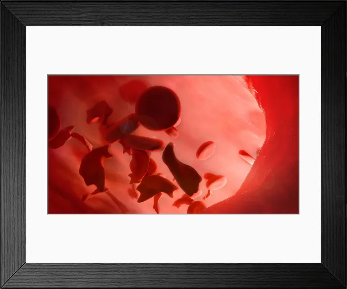Framed Print : Sickle-cell Disease Illustration