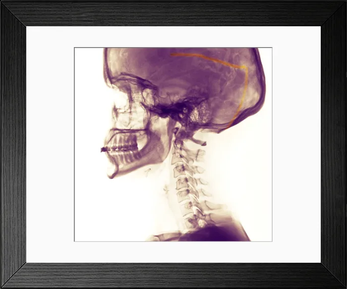 Framed Print : Ventricular Shunt for the Treatment of Hydrocephalus Framed Print : Ventricular Shunt for the Treatment of Hydrocephalus