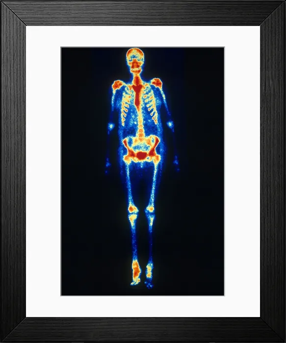Framed Print : Osteomyelitis Framed Print : Osteomyelitis