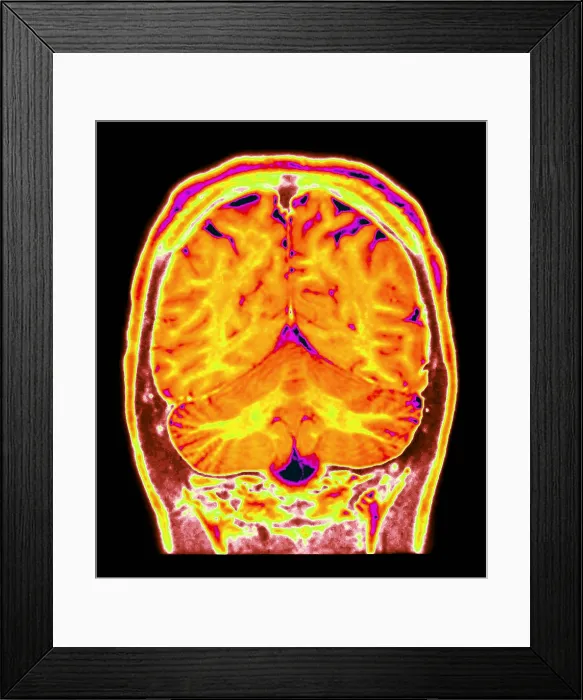 Framed Print : Cerebral MRI Framed Print : Cerebral MRI