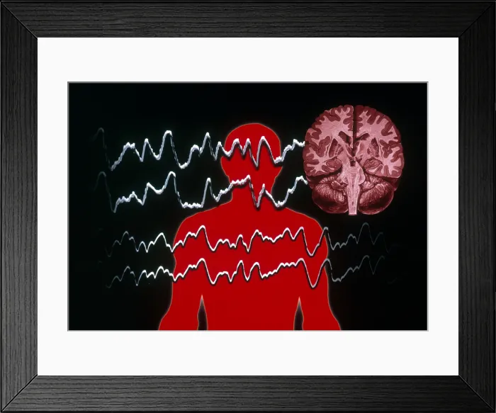 Framed Print : EEG of Tonic-clonic Seizure Framed Print : EEG of Tonic-clonic Seizure