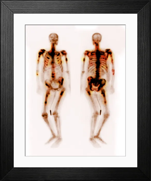 Framed Print : Bone scan showing multiple metastases Framed Print : Bone scan showing multiple metastases