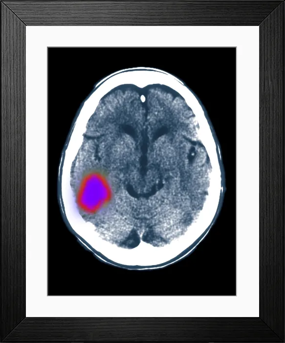 Framed Print : Cerebral CT scan showing stroke