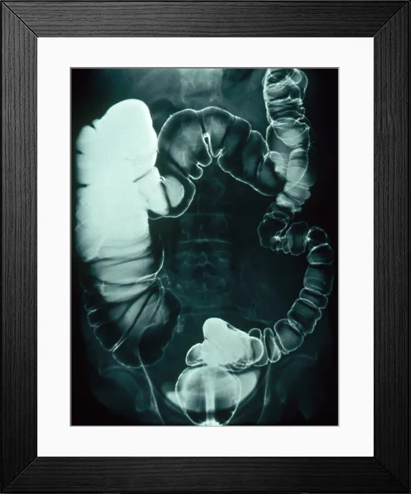 Framed Print : Large and Small Intestine, Barium X-ray Framed Print : Large and Small Intestine, Barium X-ray