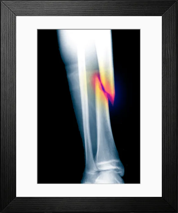 Framed Print : X-ray of fractured tibia