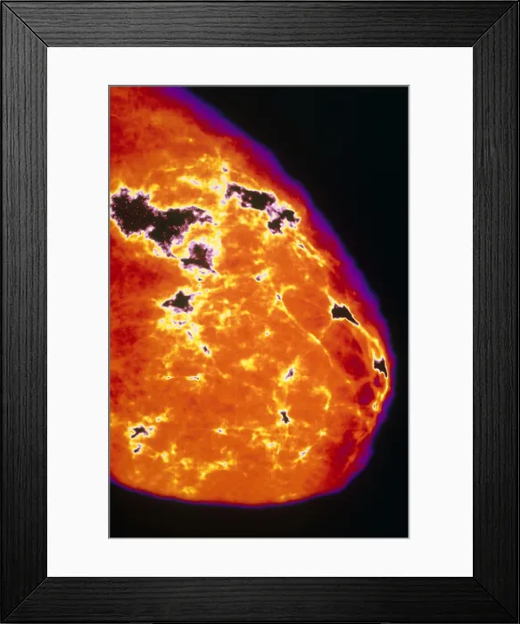 Framed Print : Mammogram. Color enhanced mammogram indicating breast cancer Framed Print : Mammogram. Color enhanced mammogram indicating breast cancer