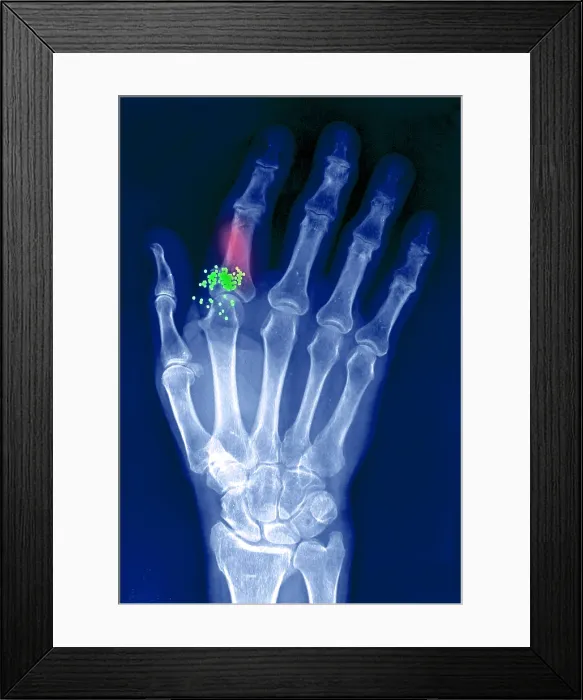 Framed Print : Hand x-ray showing shotgun wound Framed Print : Hand x-ray showing shotgun wound