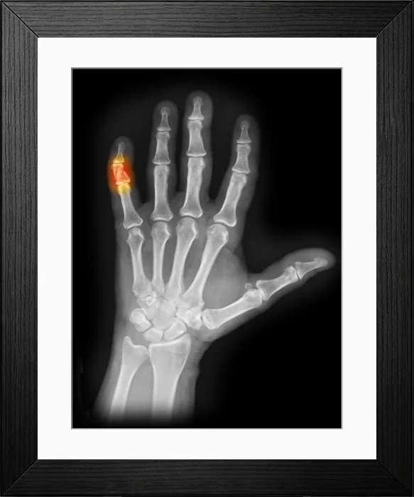 Framed Print : X-ray of Crushed Finger