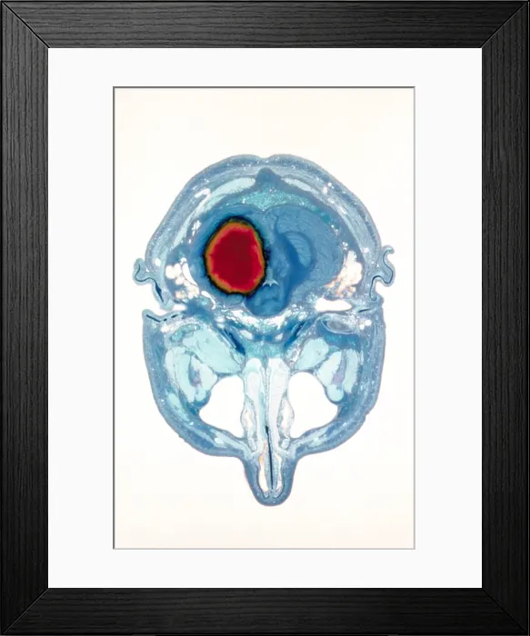 Framed Print : Cerebral hemorrhage Framed Print : Cerebral hemorrhage