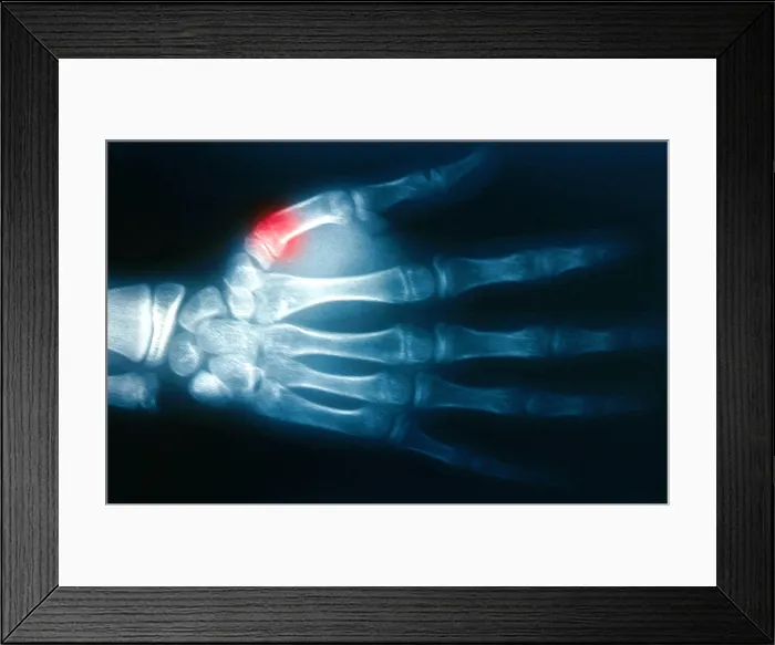 Framed Print : Fractured Thumb, X-ray Framed Print : Fractured Thumb, X-ray