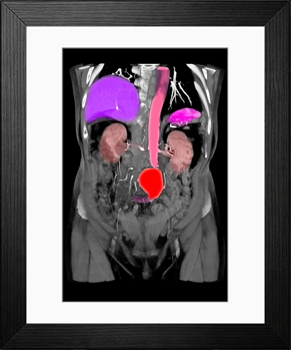 Framed Print : CT Scan of Abdominal Aortic Aneurysm
