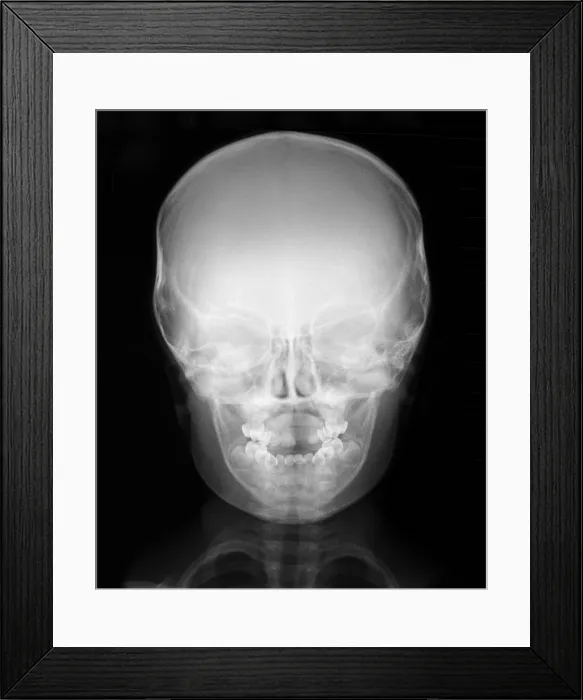 Framed Print : Head Healthy 3 Year Old Boy