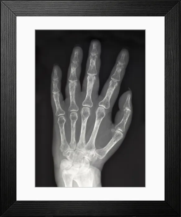 Framed Print : X-Ray Showing Severe Osteoporosis Framed Print : X-Ray Showing Severe Osteoporosis