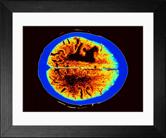 Framed Print : Brain edema Framed Print : Brain edema