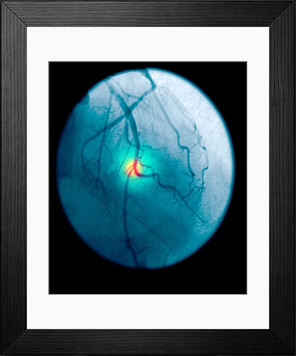 Framed Print : Angiogram of a blocked coronary artery Framed Print : Angiogram of a blocked coronary artery
