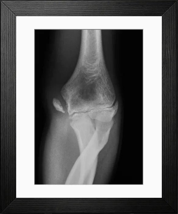 Framed Print : Little League Elbow Syndrome Framed Print : Little League Elbow Syndrome