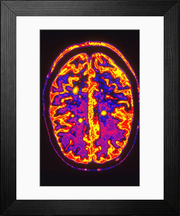 Framed Print : Human Brain with MS