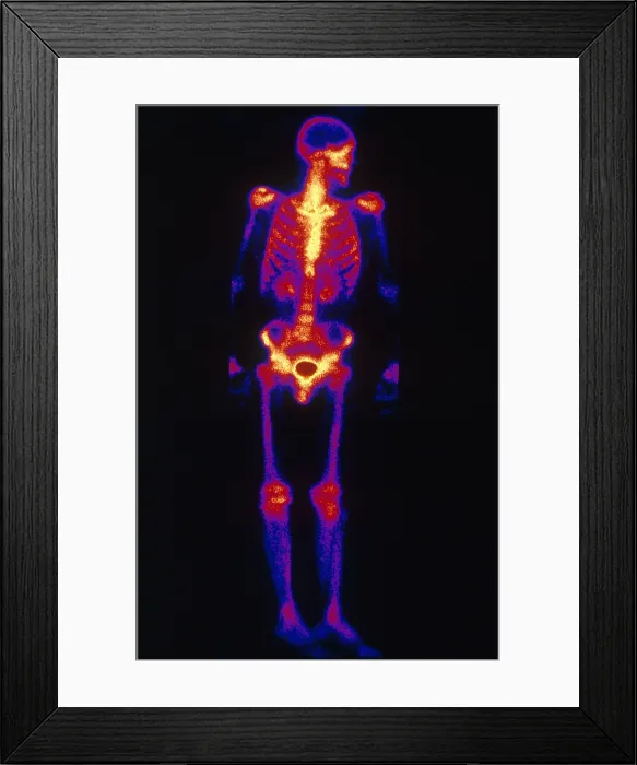 Framed Print : Normal Bone Scan Framed Print : Normal Bone Scan
