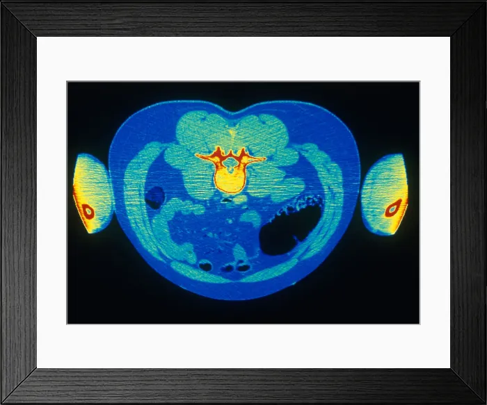 Framed Print : Abdomen, CT Scan
