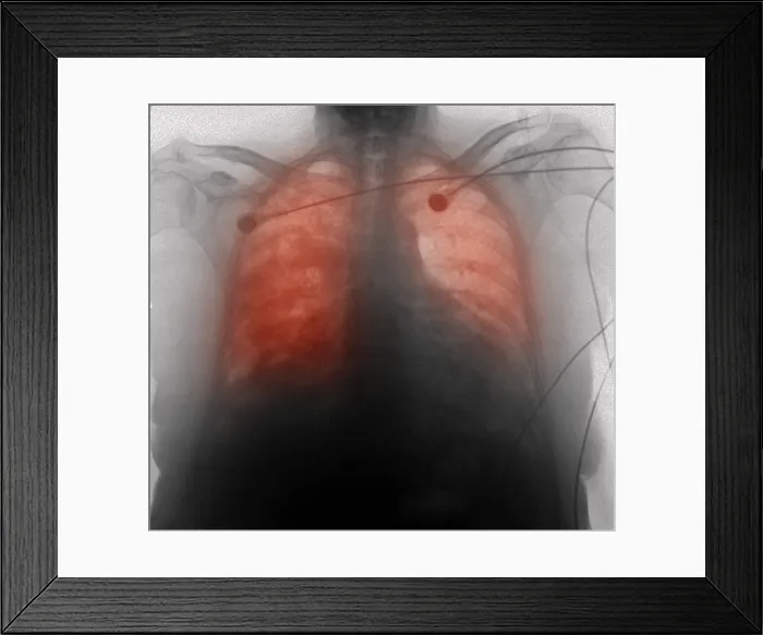 Framed Print : CXR congestive heart failure 77 year old woman Framed Print : CXR congestive heart failure 77 year old woman