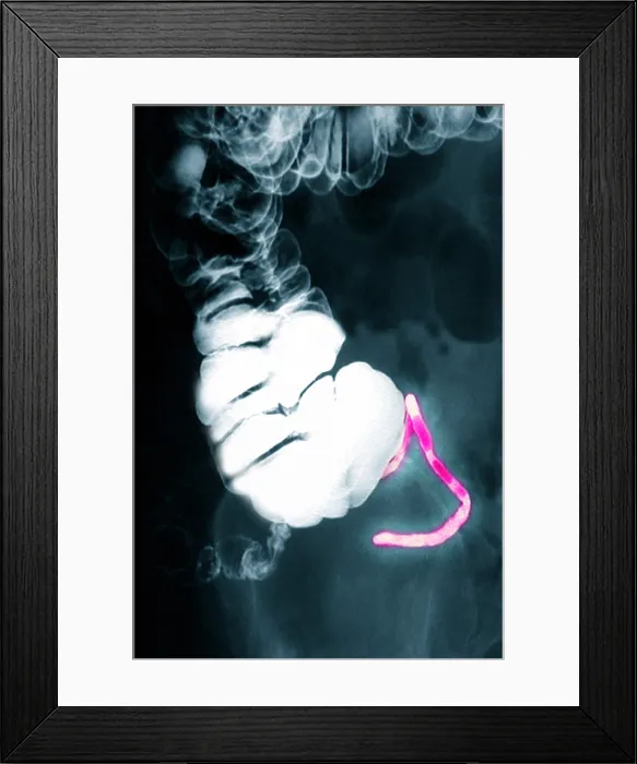 Framed Print : Appendix x-ray with barium contrast Framed Print : Appendix x-ray with barium contrast