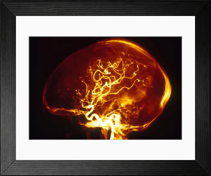 Framed Print : Aortic Arteriogram