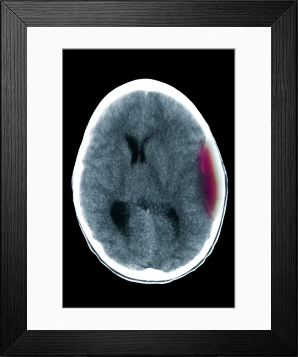 Framed Print : Cerebral CT showing epidural hematoma Framed Print : Cerebral CT showing epidural hematoma