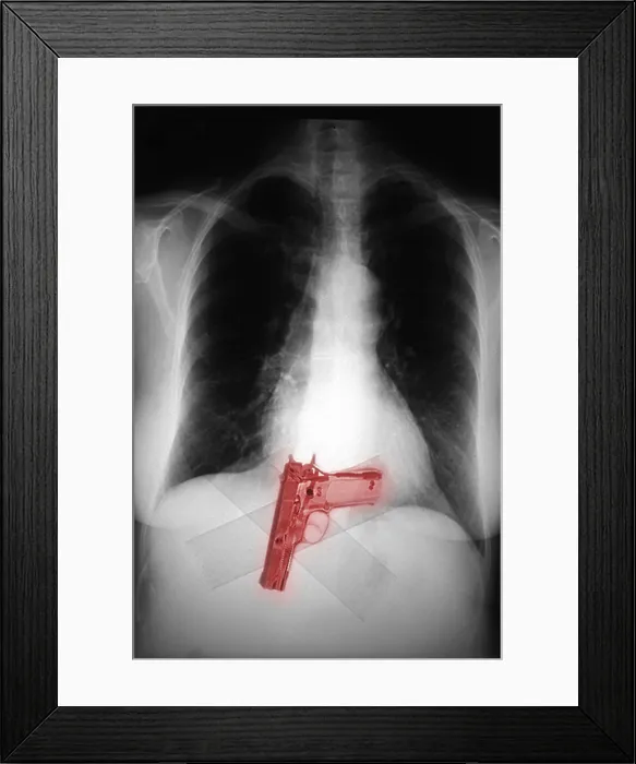 Framed Print : Chest x-ray showing hidden gun
