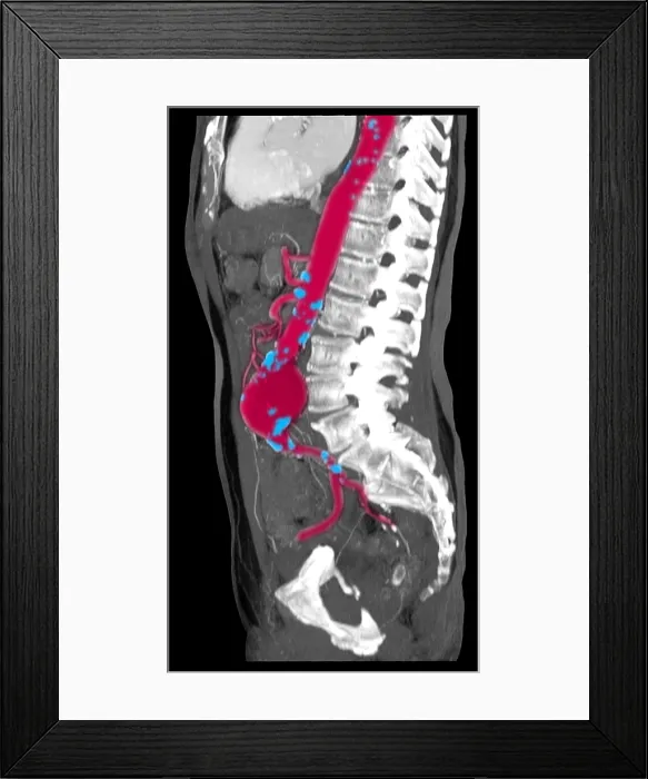Framed Print : CT Scan of Abdominal Aortic Aneurysm