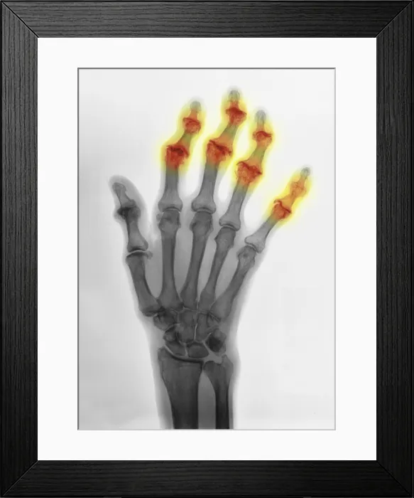 Framed Print : Degenerative Arthritis Framed Print : Degenerative Arthritis