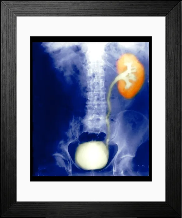 Framed Print : Renal Colic Framed Print : Renal Colic