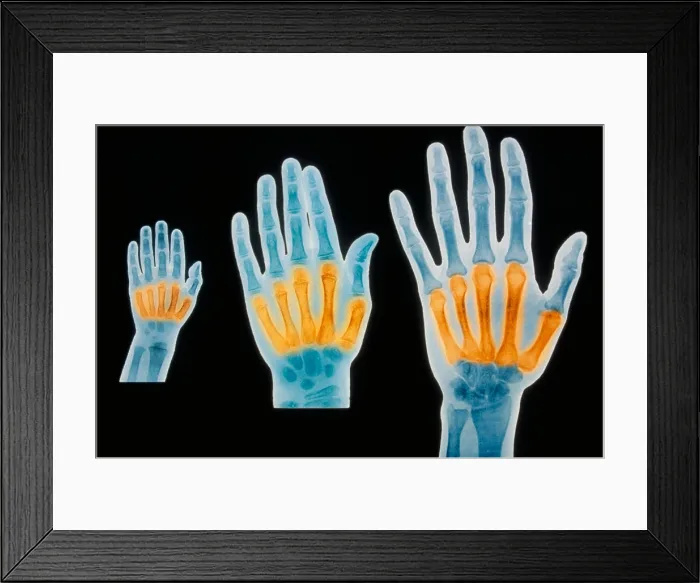 Framed Print : X-rays of 2 year old, 7 year old, and adult Framed Print : X-rays of 2 year old, 7 year old, and adult