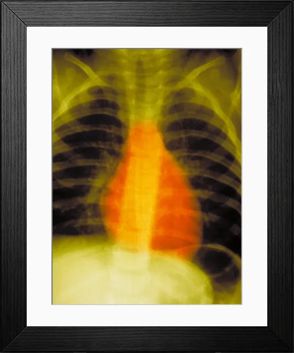 Framed Print : Normal chest x-ray Framed Print : Normal chest x-ray
