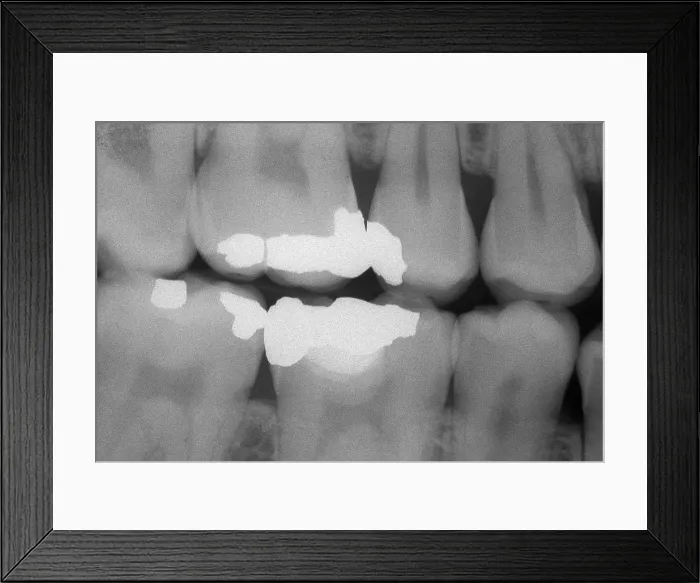 Framed Print : Teeth With Fillings, X-ray Framed Print : Teeth With Fillings, X-ray