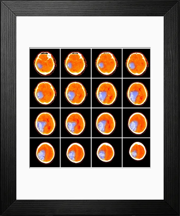 Framed Print : Hemorrhagic Stroke Framed Print : Hemorrhagic Stroke
