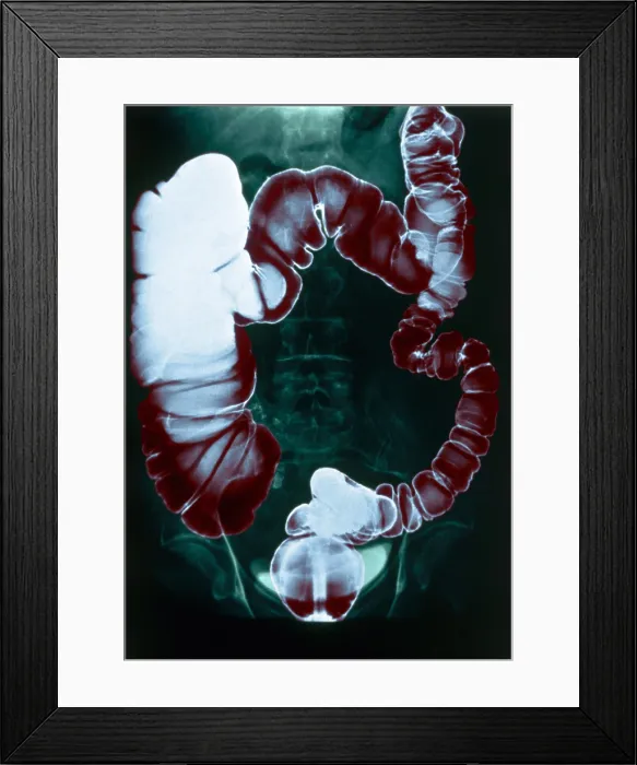 Framed Print : Colon Examination, Barium Enema Framed Print : Colon Examination, Barium Enema
