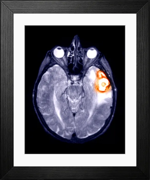 Framed Print : MRI Scan of a Brain Hemorrhage Framed Print : MRI Scan of a Brain Hemorrhage