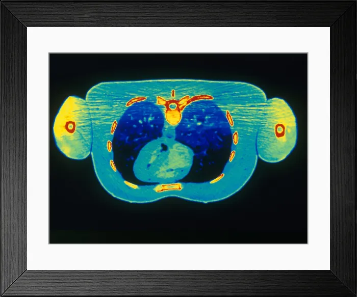 Framed Print : Chest & Heart, CT Scan Framed Print : Chest & Heart, CT Scan