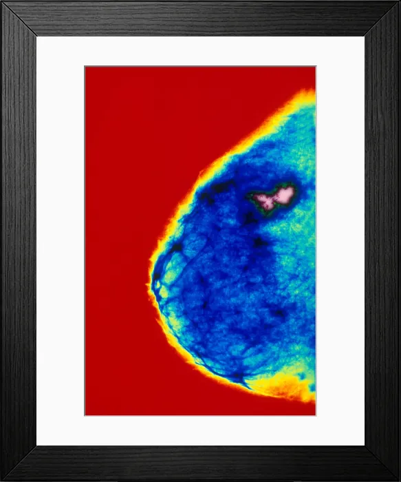 Framed Print : Mammogram indicating breast cancer. Color enhanced Framed Print : Mammogram indicating breast cancer. Color enhanced